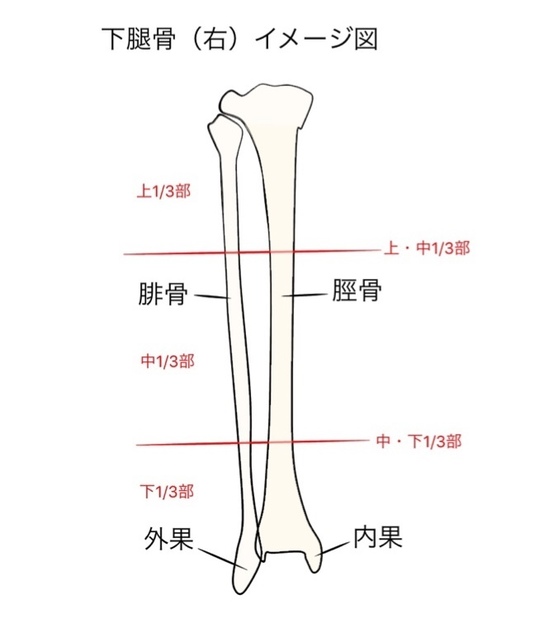 下腿骨骨折（脛・腓骨骨折）の基礎知識